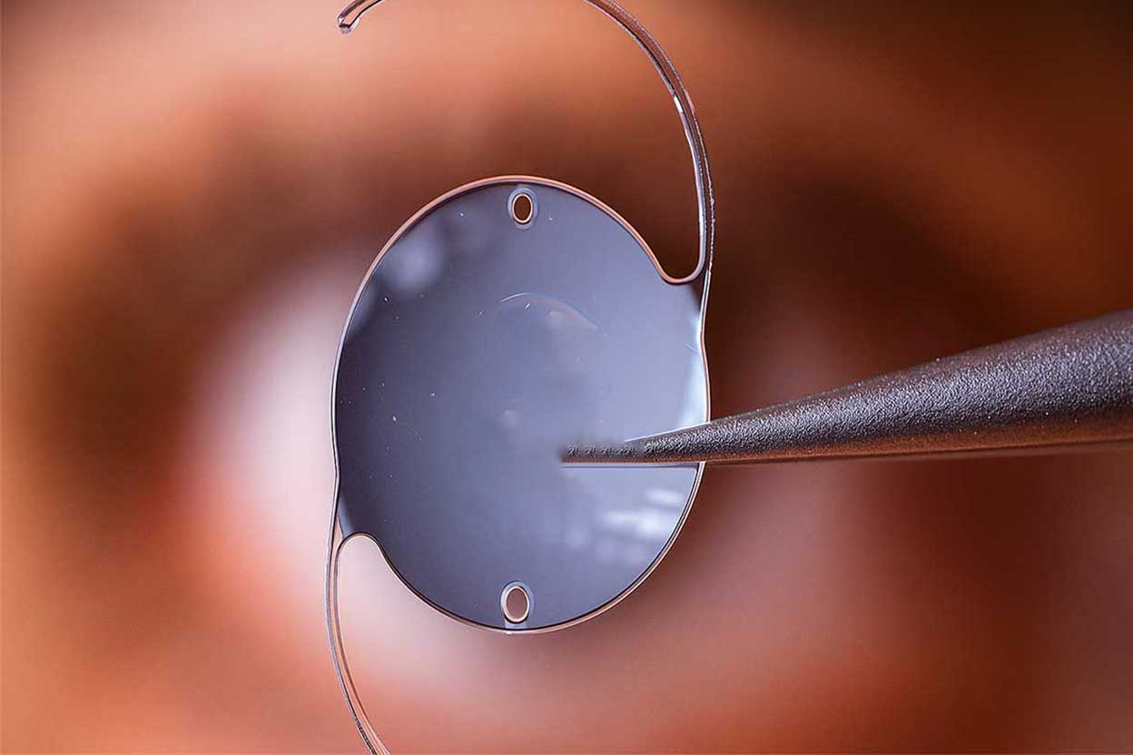 göz-içi-mercek-tedavisi